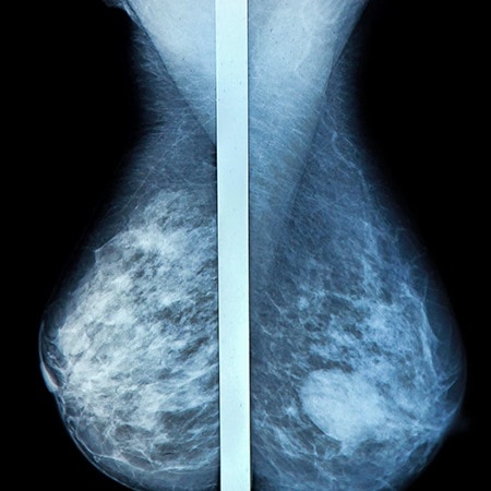 Screening for brystkræft – hvem, hvad og hvor tit