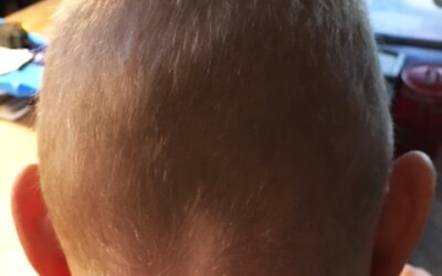 Kemoterapi kan føre til permanent hårtab